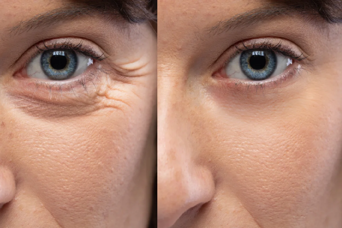 Before and after Botox treatment showing reduced crow's feet and smoother skin around the eyes at LoneStar Aesthetics and Wellness.